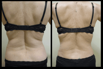 Liposuction Before and After Patient 7