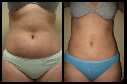 Stomach Liposuction Before and After Patient 8