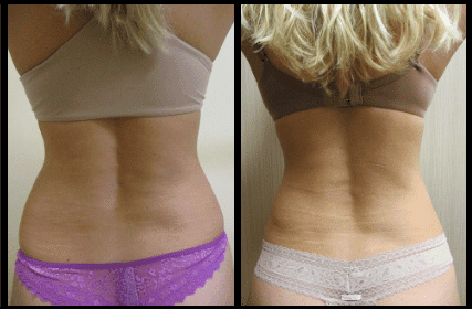 Back Liposuction Before and After Patient 9