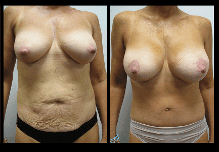 Mommy Makeover Before and After Patient 8