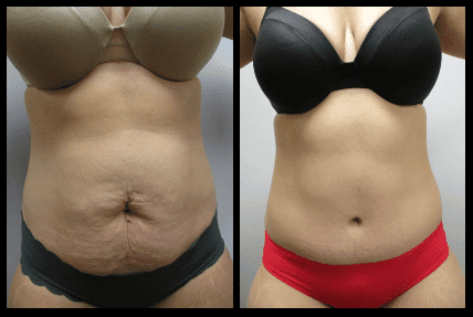 Tummy Tuck Before and After Patient 1