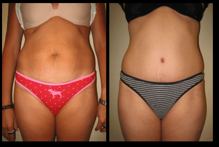 Tummy Tuck Before and After Patient 11