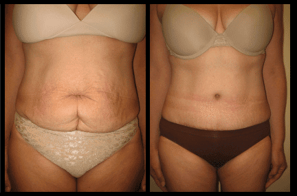 Tummy Tuck Before and After Patient 13