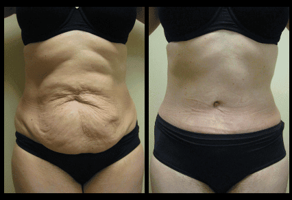 Tummy Tuck Before and After Patient 14