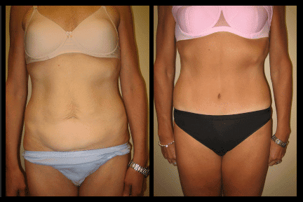 Tummy Tuck Before and After Patient 15