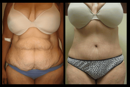 Tummy Tuck Before and After Patient 16