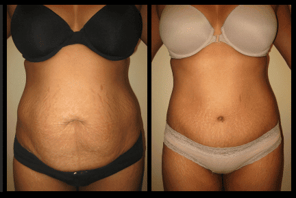 Tummy Tuck Before and After Patient 17