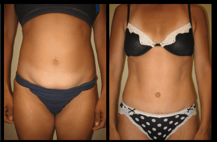 Tummy Tuck Before and After Patient 18