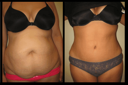 Tummy Tuck Before and After Patient 19