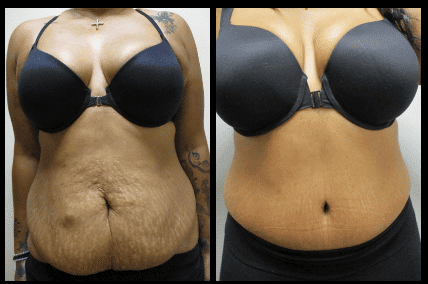 Tummy Tuck Before and After Patient 2