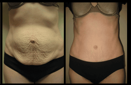 Tummy Tuck Before and After Patient 20