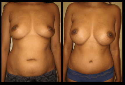 Tummy Tuck Before and After Patient 21