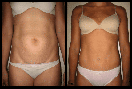 Tummy Tuck Before and After Patient 22