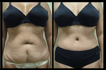 Tummy Tuck Before and After Patient 23