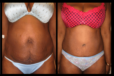 Tummy Tuck Before and After Patient 24