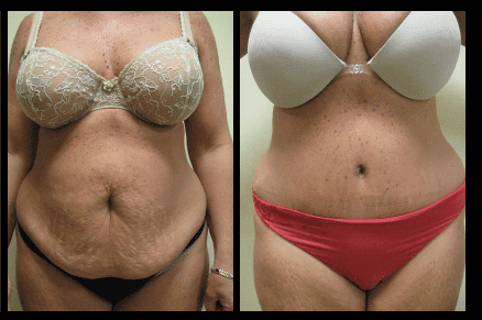 Tummy Tuck Before and After Patient 25