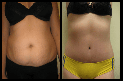 Tummy Tuck Before and After Patient 26