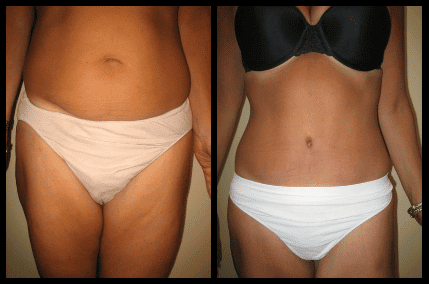 Tummy Tuck Before and After Patient 27