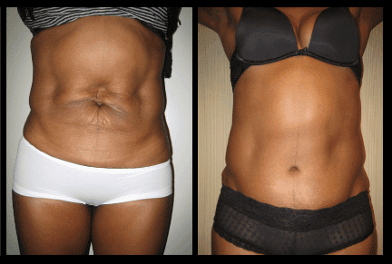 Tummy Tuck Before and After Patient 28