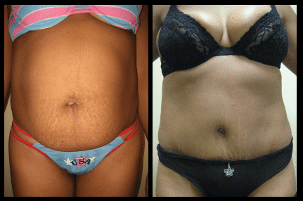 Tummy Tuck Before and After Patient 29