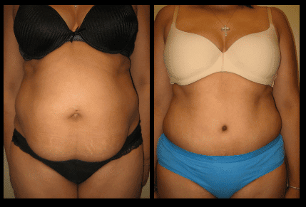 Tummy Tuck Before and After Patient 30