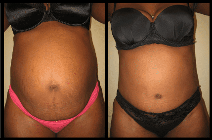 Tummy Tuck Before and After Patient 31