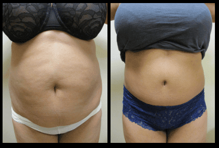 Tummy Tuck Before and After Patient 5