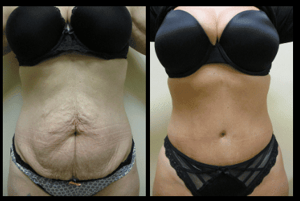 Tummy Tuck Before and After Patient 6