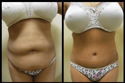 Tummy Tuck Before and After Patient 7