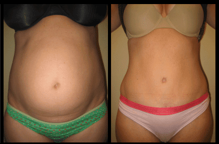 Tummy Tuck Before and After Patient 8