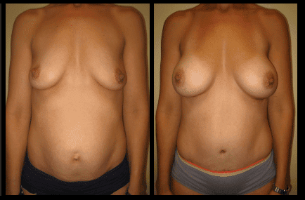 Tummy Tuck Before and After Patient 9