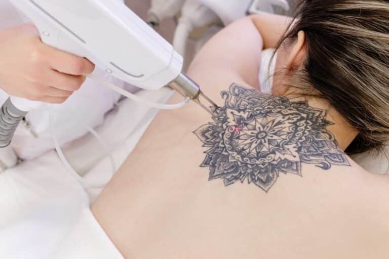 How many sessions of tattoo removal are typically needed for complete results?