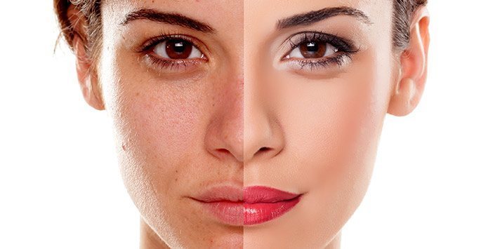 What is Laser Fractional Resurfacing and how does it work?