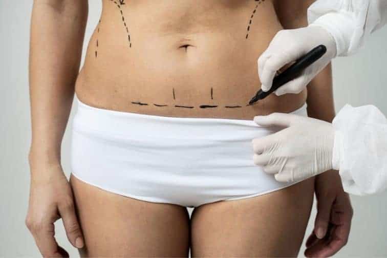 Tighten and Tone: The Benefits of Tummy Tuck Surgery Revealed