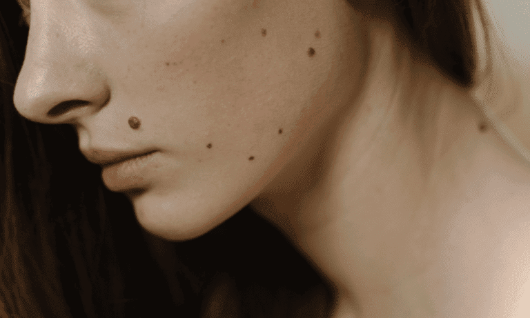 Mole Removal Recovery Guide: Tips for Healing and Beautiful Skin