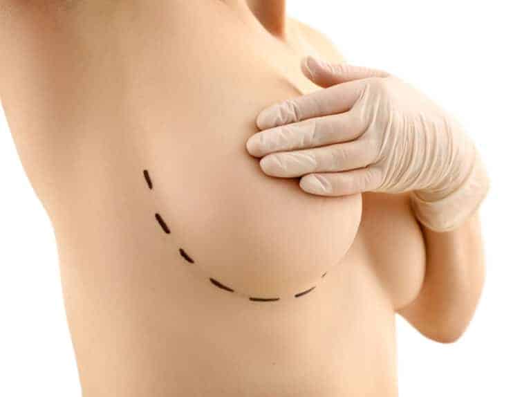 Inverted Nipple Correction: Mastering the Double Triangle Technique