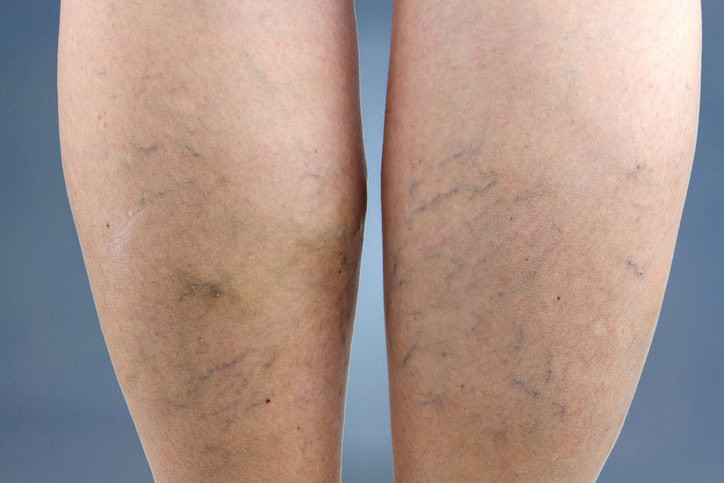 Varicose Vein Treatment: Comprehensive Guide to Relief