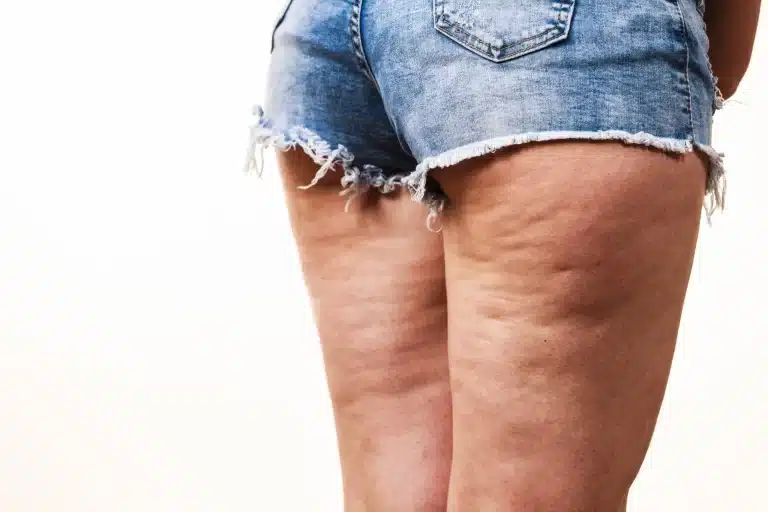 Cellulite: Understanding Causes, Body Types & Treatment Options