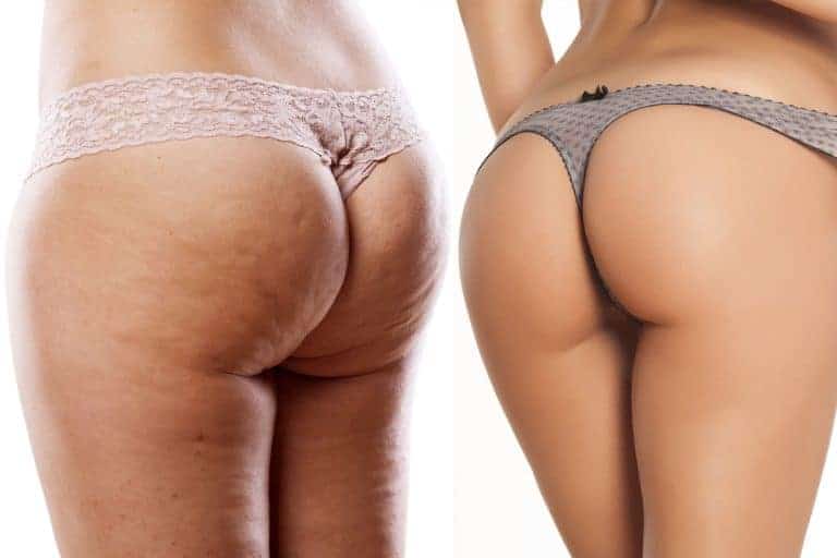 Fat Transfer for Cellulite Treatment | Effective Solutions in NYC