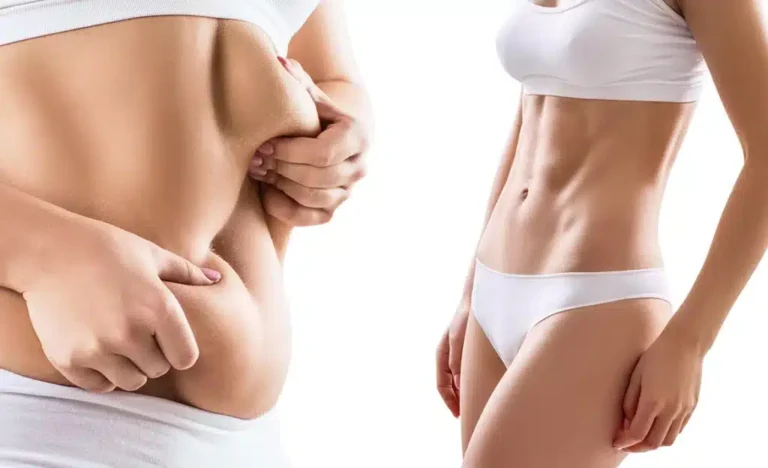 How Liposuction Can Target Stubborn Fat Areas Effectively