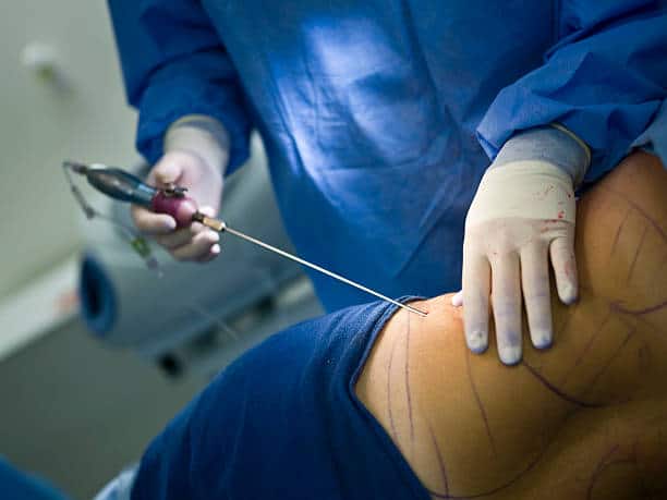 The Evolution of Liposuction: Past, Present, and Future Insights