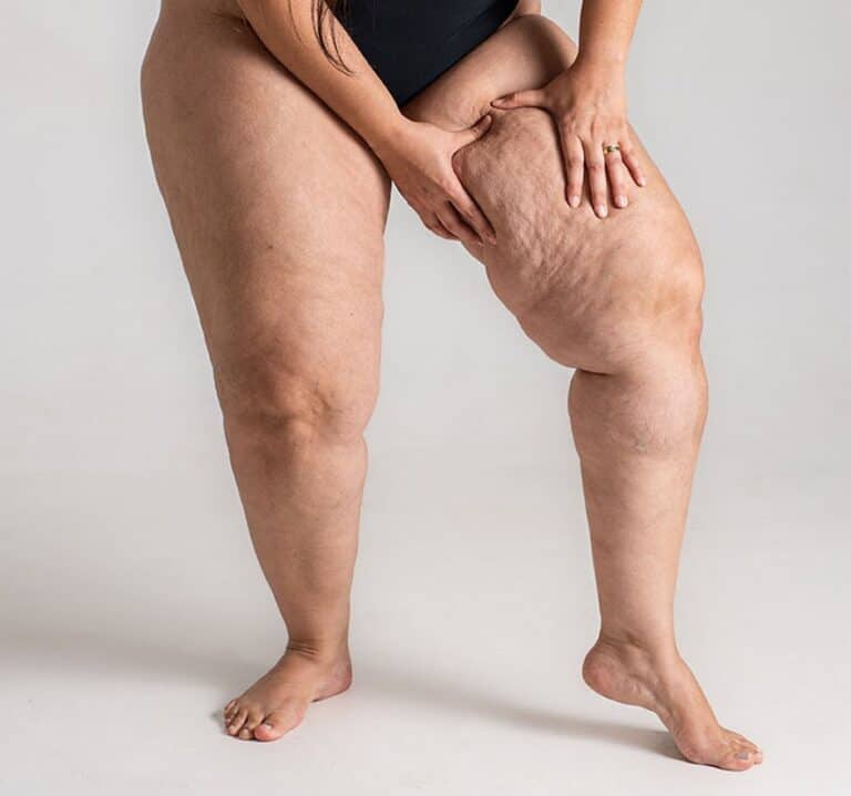 Liposuction for My Painful Fat Syndrome: A Personal Journey with Lipedema