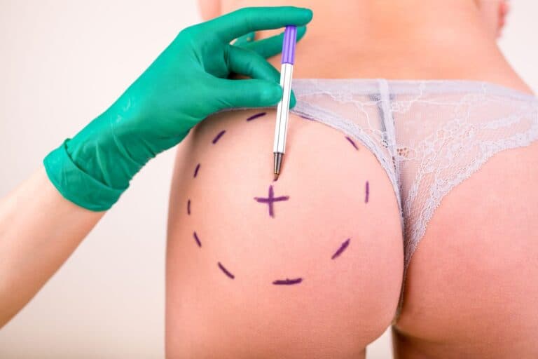 5 Things You Didn’t Know About Brazilian Butt Lifts