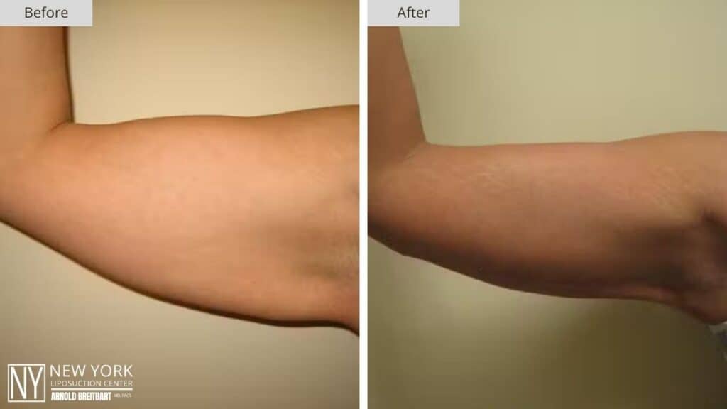 Arm Lift Before and After Patient 2