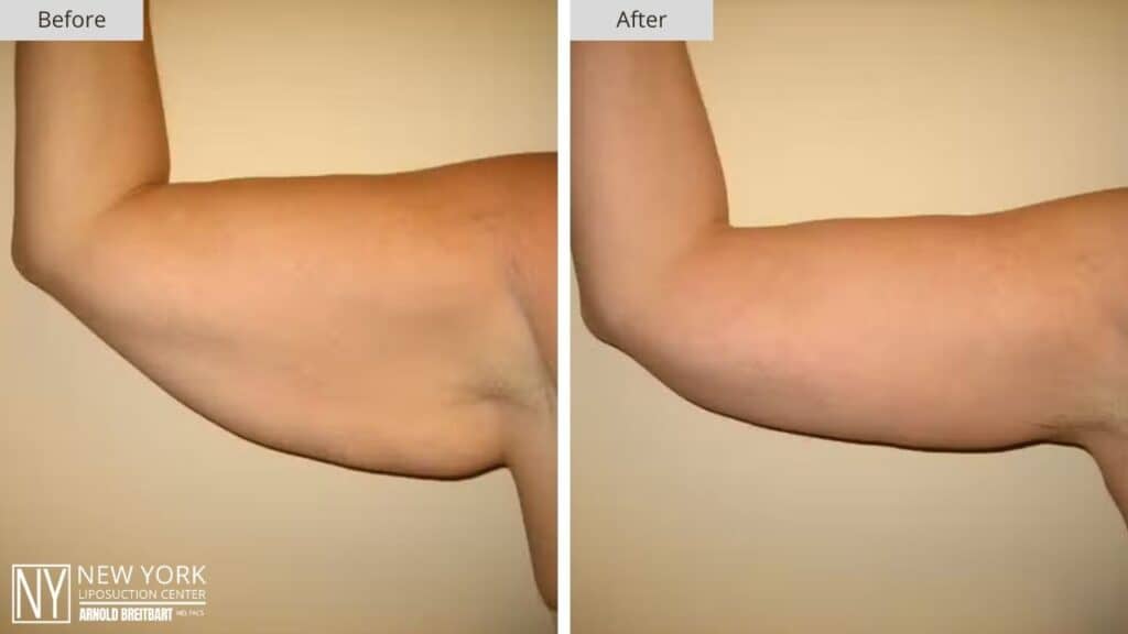 Arm Lift Before and After Patient 3