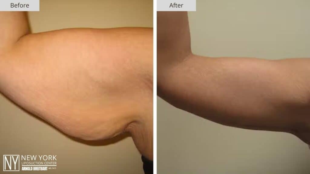 Arm Lift Before and After Patient 4