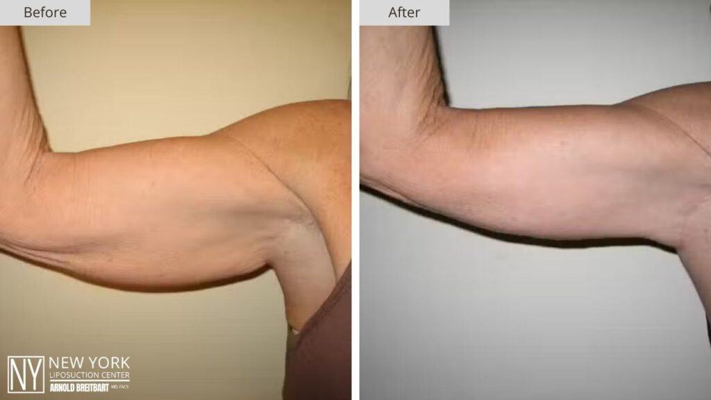 Arm Lift Before and After Patient 5