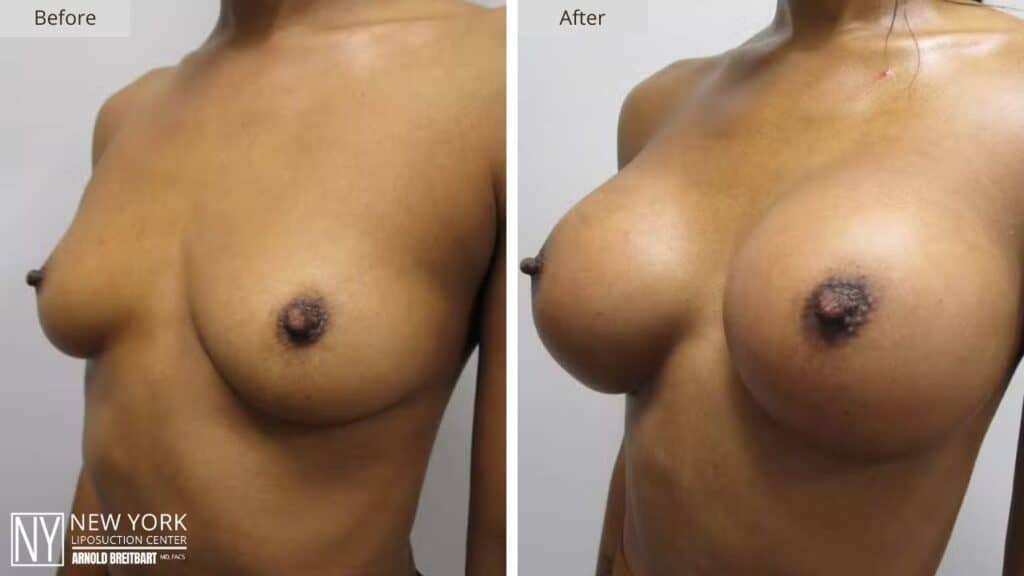 Breast Augmentation Before and After Patient 1