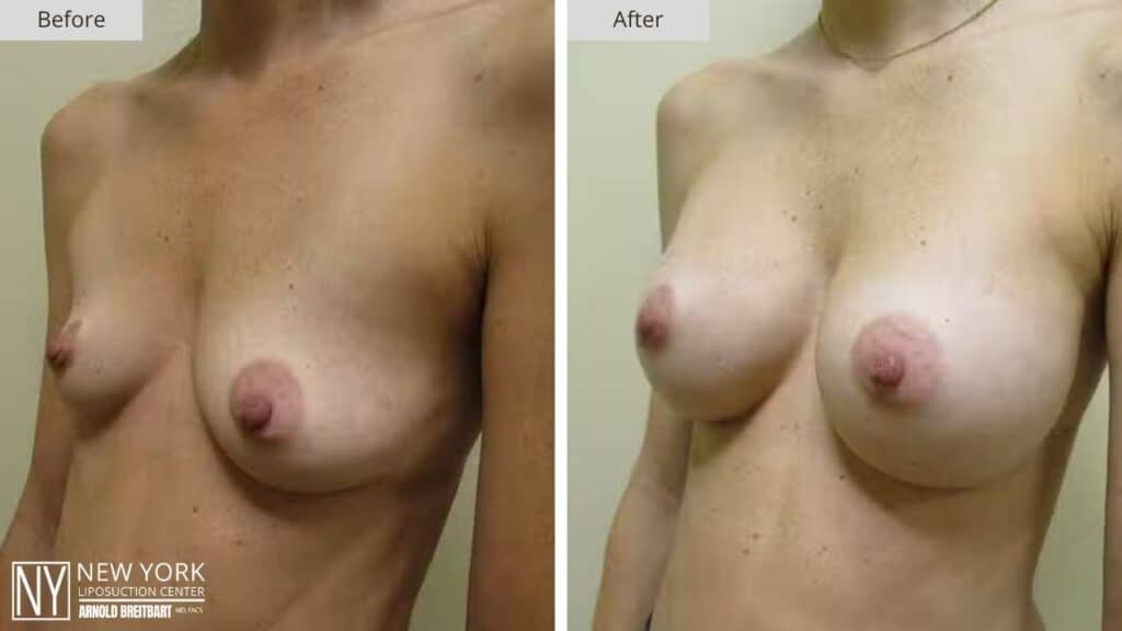 Breast Augmentation Before and After Patient 2