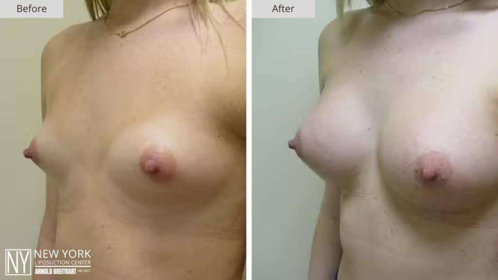 Breast Augmentation Before and After Patient 3